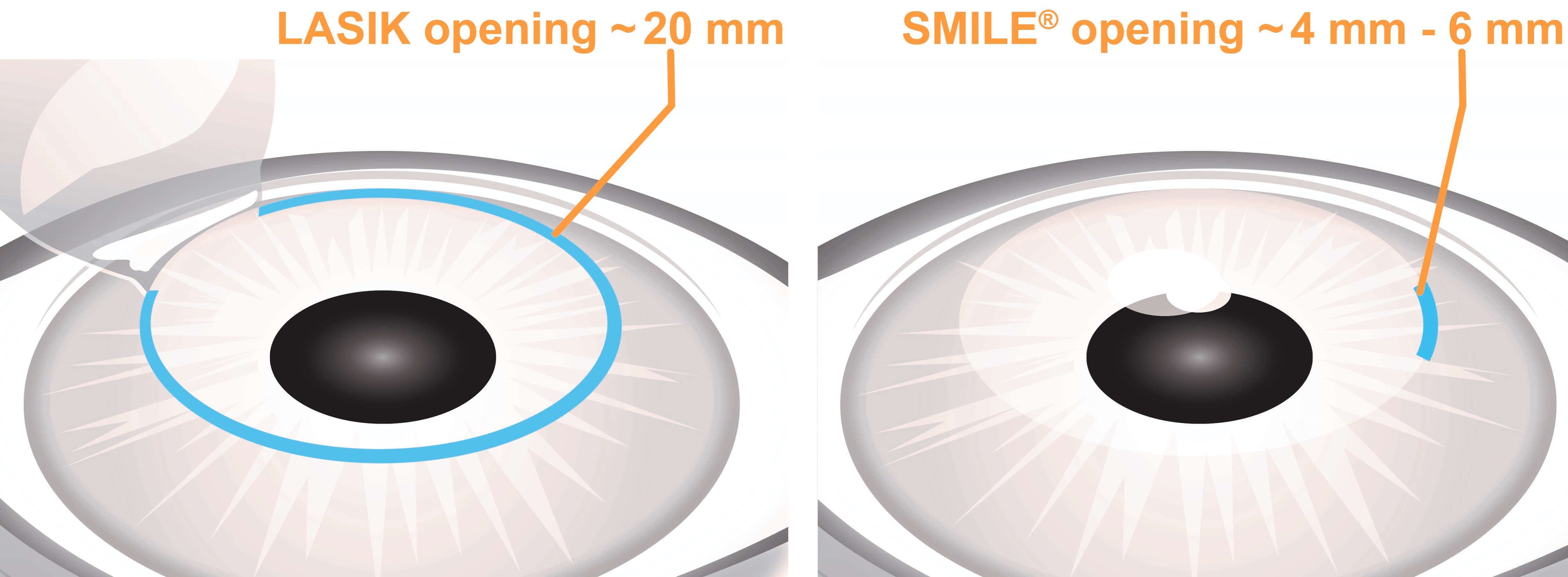 После лазерной коррекции зрения что нельзя делать. Лазерная коррекция зрения LASIK. LASIK smile операция. Ласик Смайл коррекция зрения.